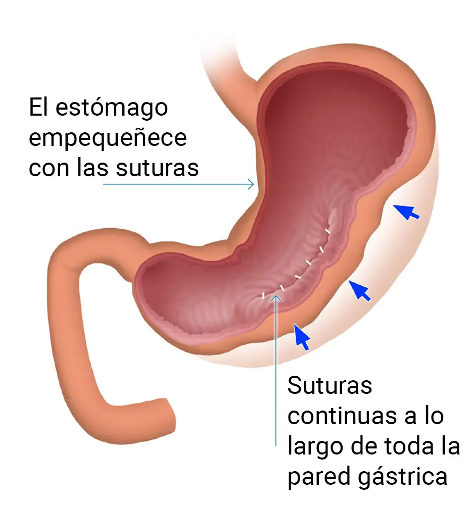 metodo-reto-endoscopia-obesidad