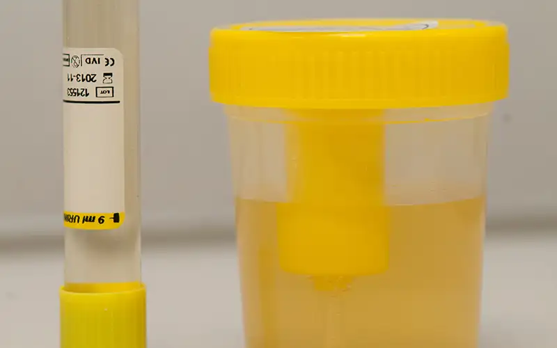 Imagen de recogida de orina para análisis. Clínica Universidad de Navarra