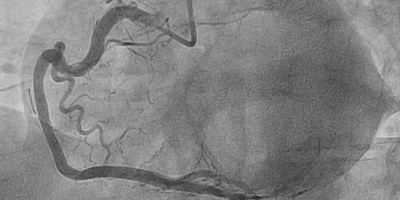 angioplastia-post-stent