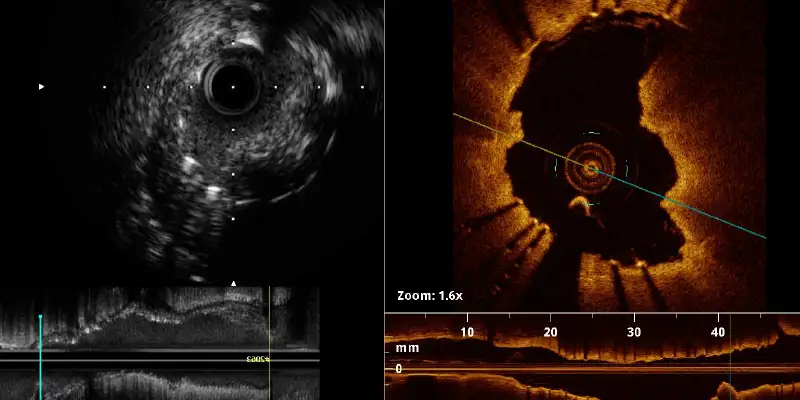 img-destacado-ivus-oct