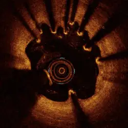 img-destacado-tomografia-coherencia-optica-corazon
