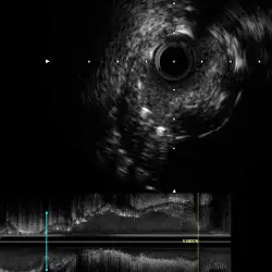 img-destacado-ultrasonido-coronario-ivus