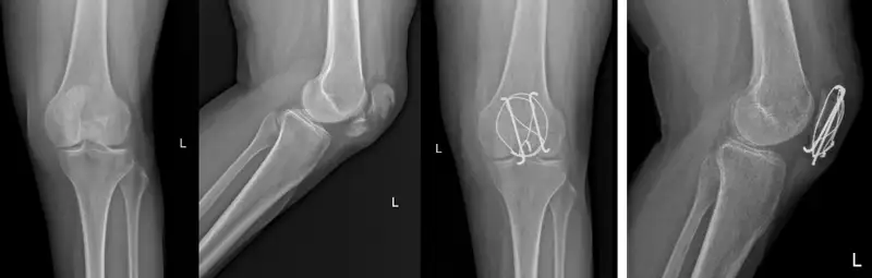 cerclaje-fractura-rotula