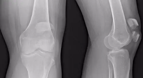 fractura-rotula-radiografia