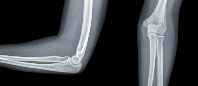 img-destacado-radiografia-codo