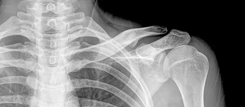 img-destacado-radiografia-hombro