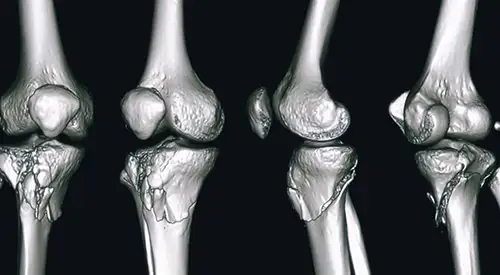 img-fractura-meseta-laprade