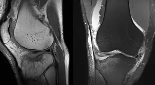img-hundimiento-meseta-fractura-tibia