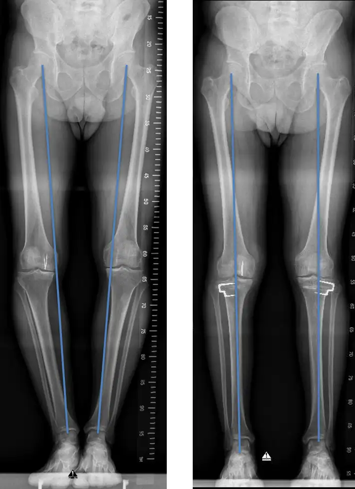 img-osteotomia-correctora