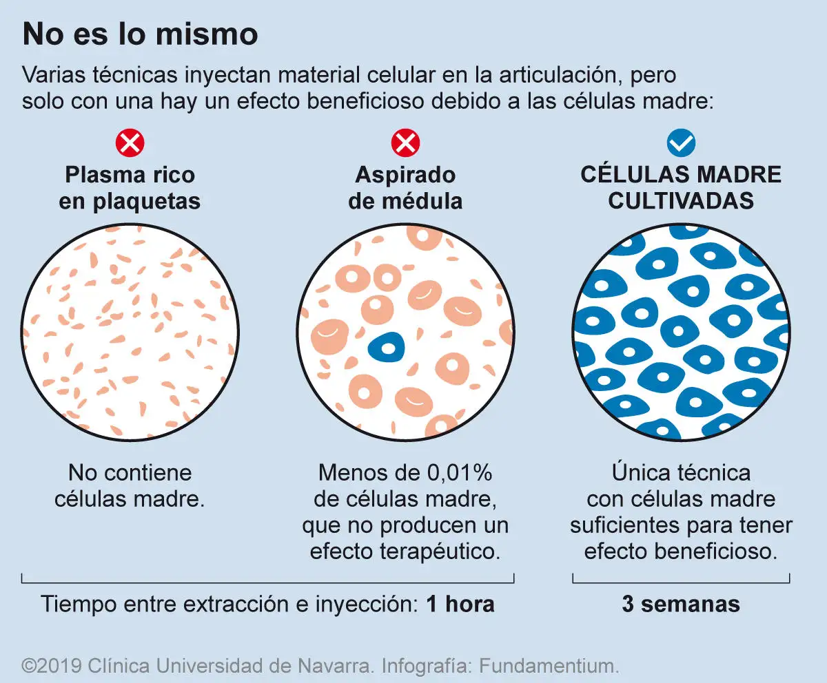 Inyecciones intraarticulares para la artrosis de rodilla