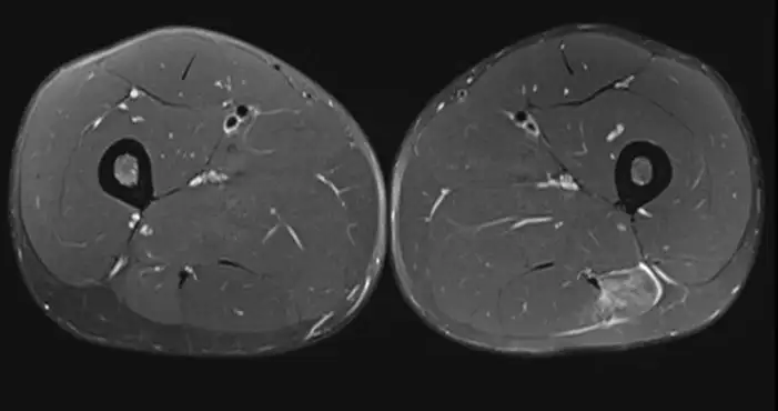 lesion-biceps-femoral-axial