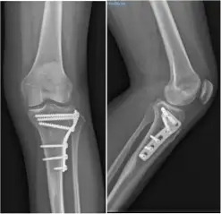 osteosintesis-fractura-tibia