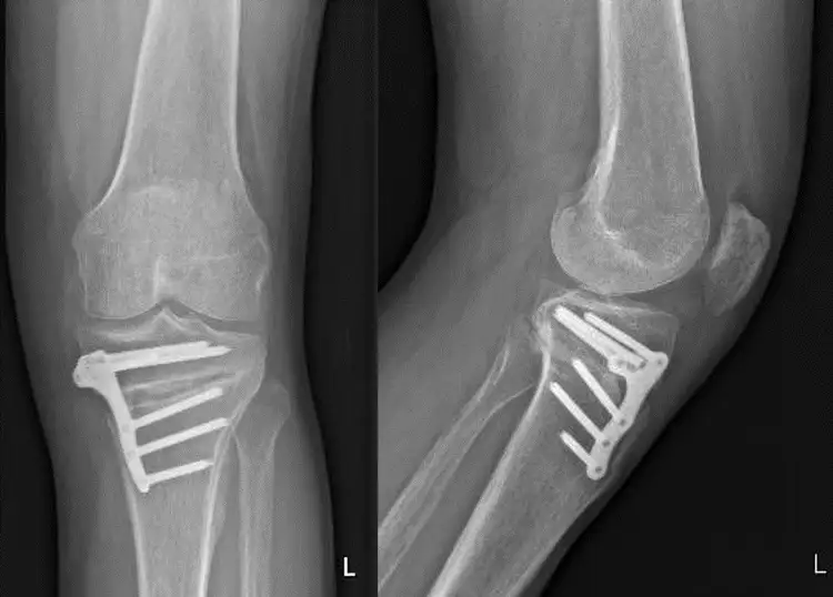 osteotomia-rodilla-artrosis-rodilla Radiografía de una osteotomía de rodilla para tratar la artrosis de rodilla. Clínica Universidad de Navarra