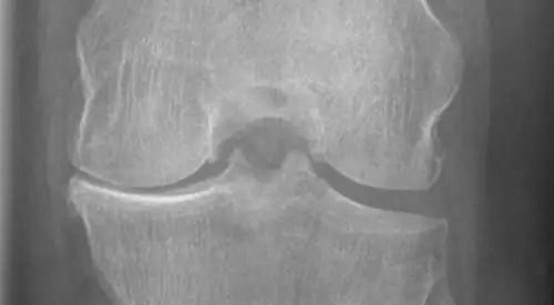 pinzamiento-medial-rodilla