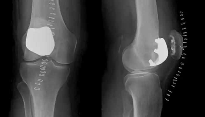 protesis-femoropatelar-rodilla
