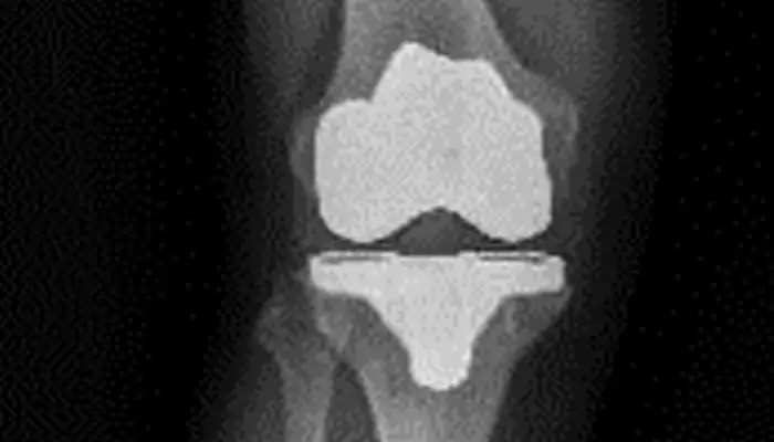 protesis-rodilla