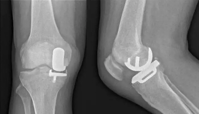 Los grados de la artrosis de rodilla - ITRAMED