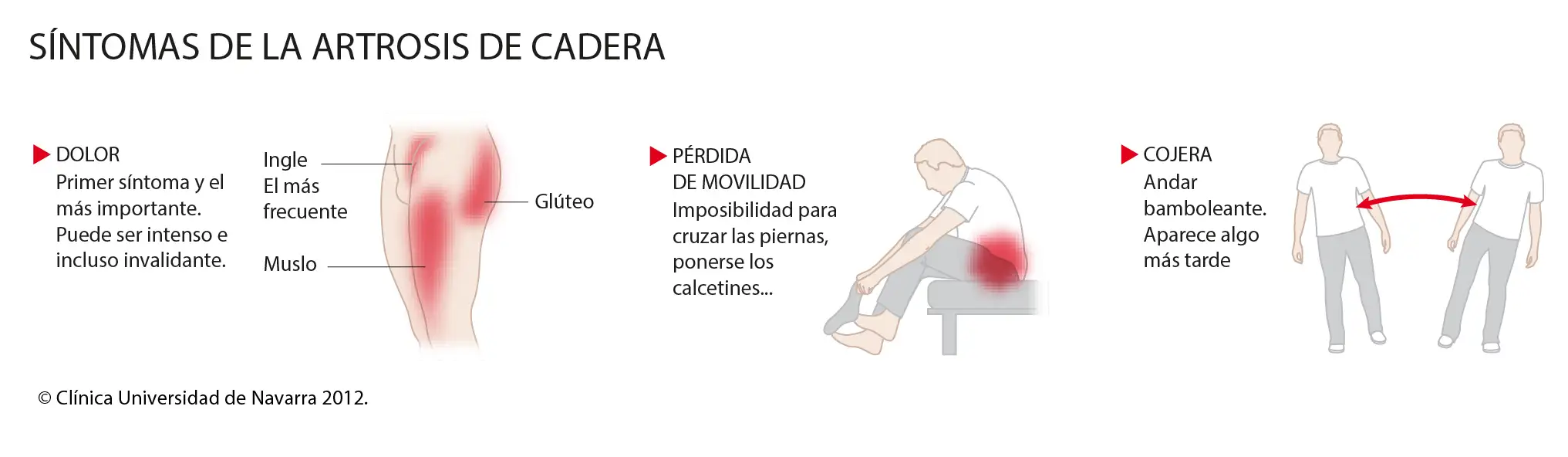 sintomas-artrosis-cadera <p>Conozca los síntomas más frecuentes que puede presentar un paciente con artrosis de cadera. </p>