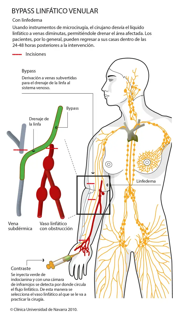 Bypass lymphaticoveineux pour le traitement du lymphœdème
