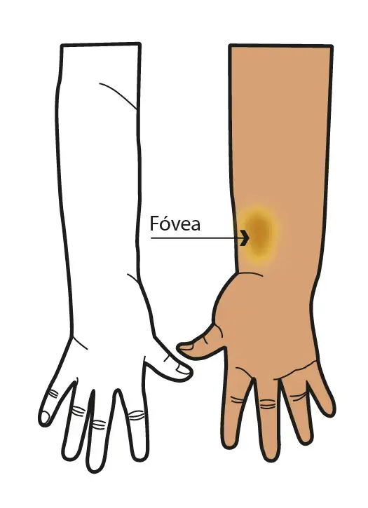 Stade I du lymphœdème