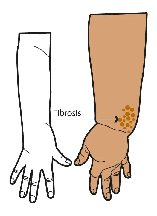 Stade II du lymphœdème