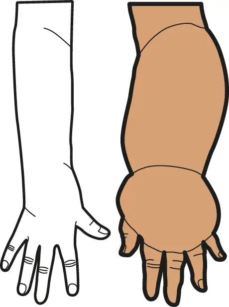 Stade III du lymphœdème