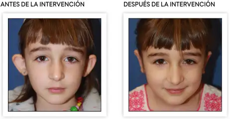 resultados_otoplastia <p>Resultados tras la intervención de otoplastia, orejas en soplillo </p>