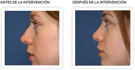 resultados_rinoplastia