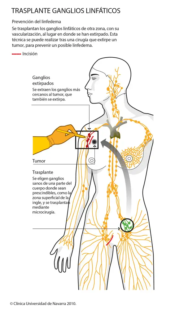 Transplantation de ganglions lymphatiques pour le traitement du lymphœdème