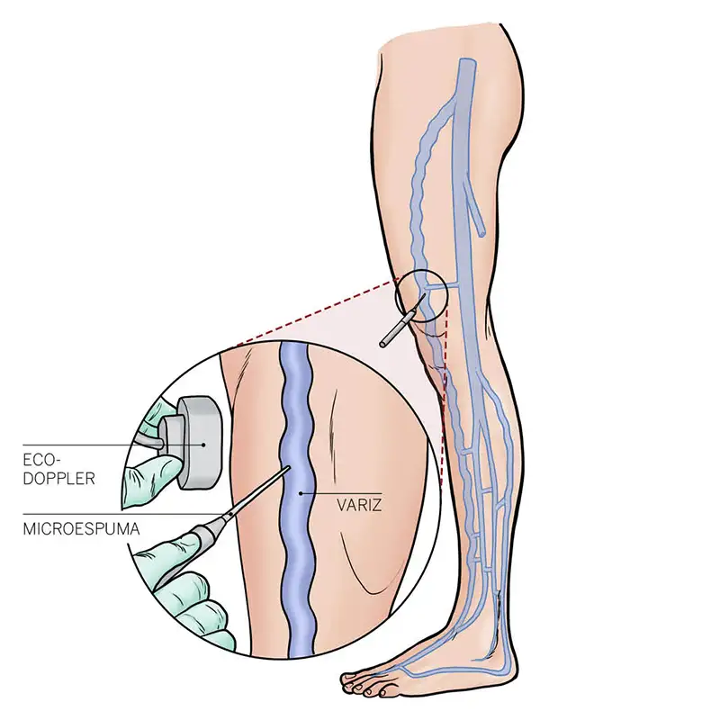 img-destacado-microespuma-varices