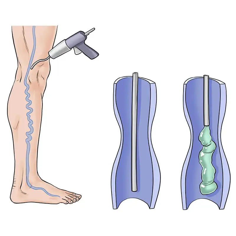 img-destacado-sellado-varices