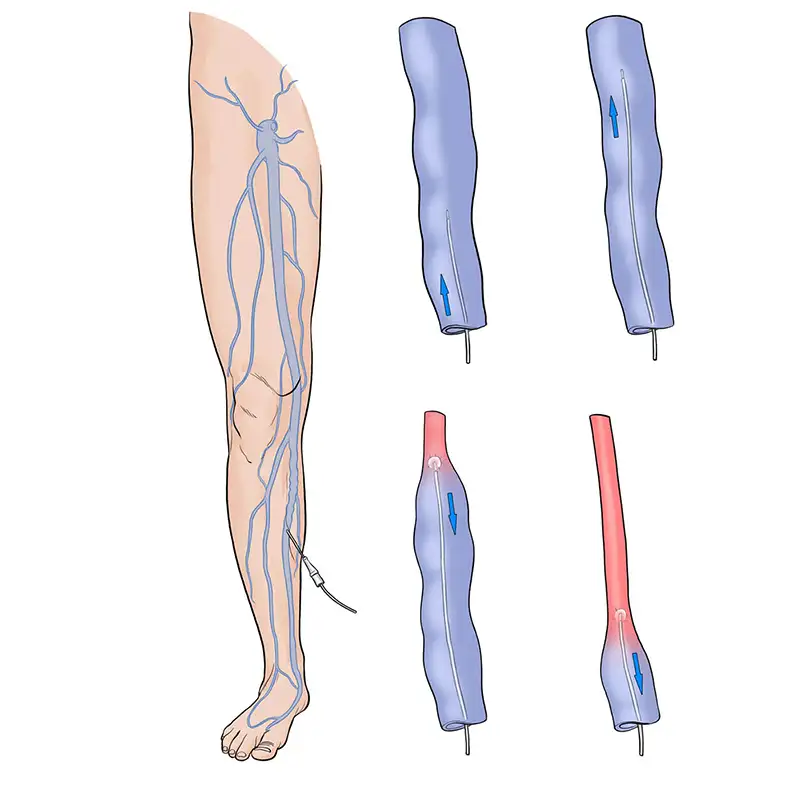 img-destacado-termoablacion-varices