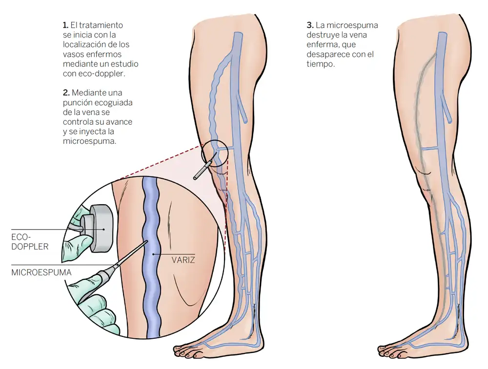 microespuma-varices