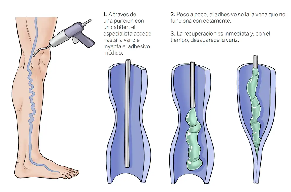 sellado-adhesivo-varices