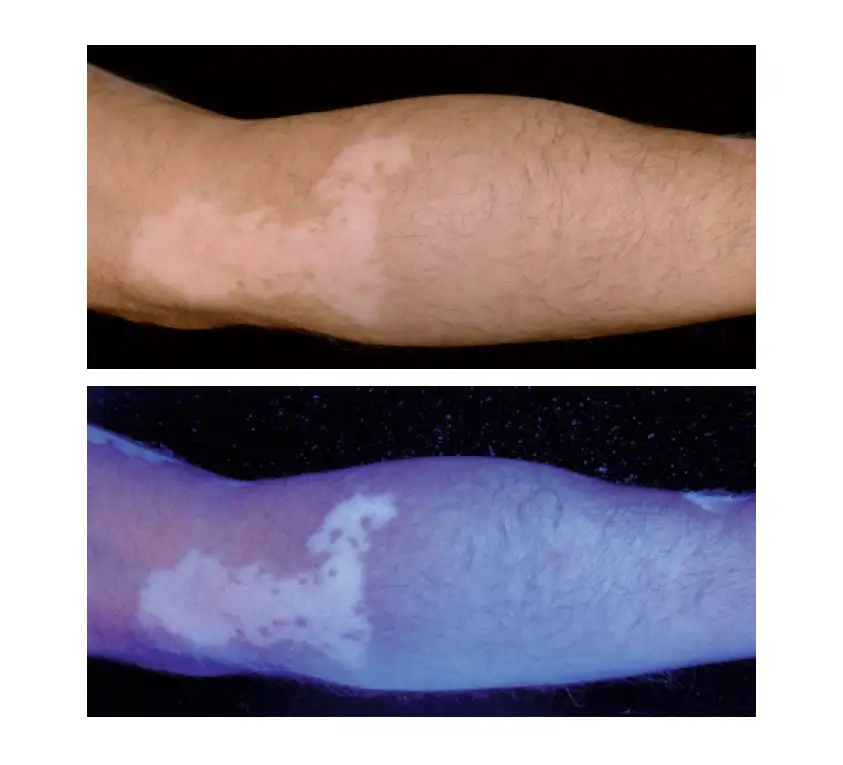 lampara-wood-vitiligo Imagen del diagnóstico del vitíligo con la lámpara de Wood