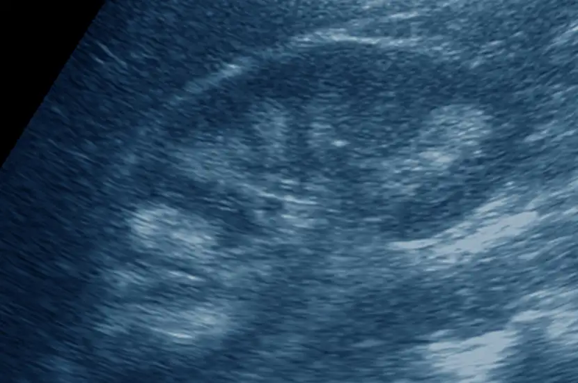 img-destacado-ecografia-renal