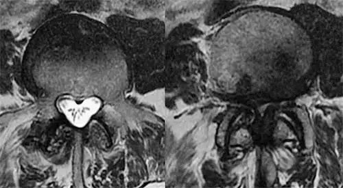 estenosis-canal Resonancia magnética de un paciente con estenosis del canal medular