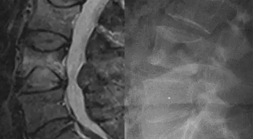 fractura-vertebral Imagen de una fractura vertebral. Clínica Universidad de Navarra