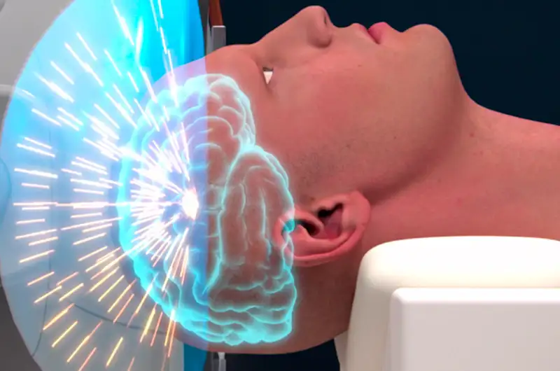 La Clínica Universidad de Navarra incorpora el modelo más avanzado de ultrasonidos de alta intensidad para el tratamiento de pacientes con temblor esencial y temblor de la enfermedad de Parkinson.