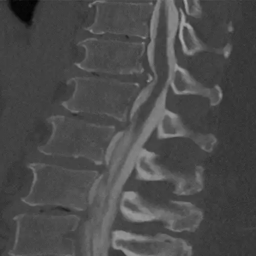 MieloTAC de hernia discal torácica. Clínica Universidad de Navarra