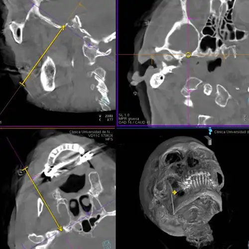 neuralgia-trigemino-termocoagulacion