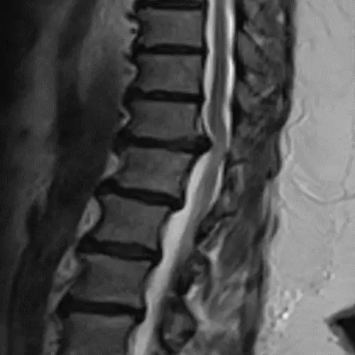 Resonancia magnética de hernia discal torácica. Clínica Universidad de Navarra