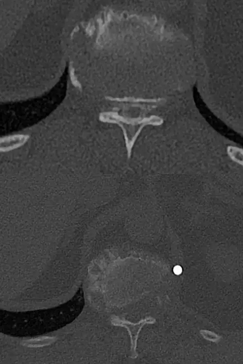 TAC pre y post cirugía hernia discal torácica. Clínica Universidad de Navarra