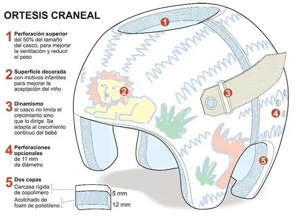 ortesis-craneal <p>La ortesis craneal es un casco especial de remodelado del cráneo, fabricado a medida, para corregir las deformidades en la cabeza de los recién nacidos.</p>