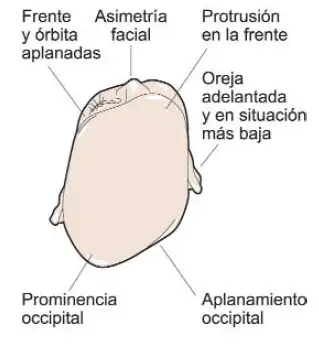 signos-plagiocefalia <p>Signos que aparecen en un recién nacido que sufre plagiocefalia posicional </p>