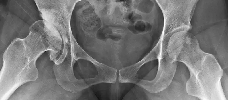img-radiografia-caderas-nino