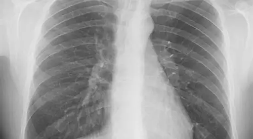 img-radiografia-torax <p>Radiografía simple de tórax </p>