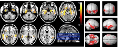 img-2-regiones-atrofia-enfermedad-alzheimer