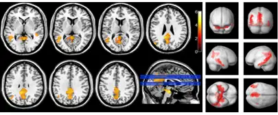 img-diferencias-perfusion-deterioro-cognitivo