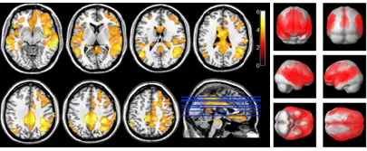 img-diferencias-perfusion-enfermedad-alzheimer